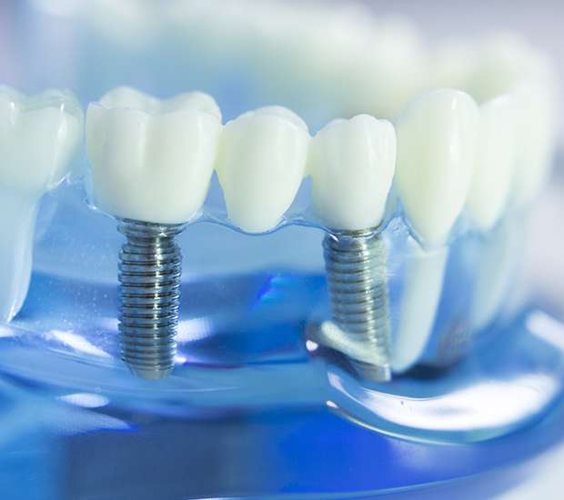 East Hanover Dental Implants