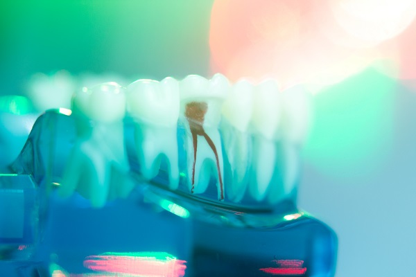 The FAQs Of Root Canal Treatment