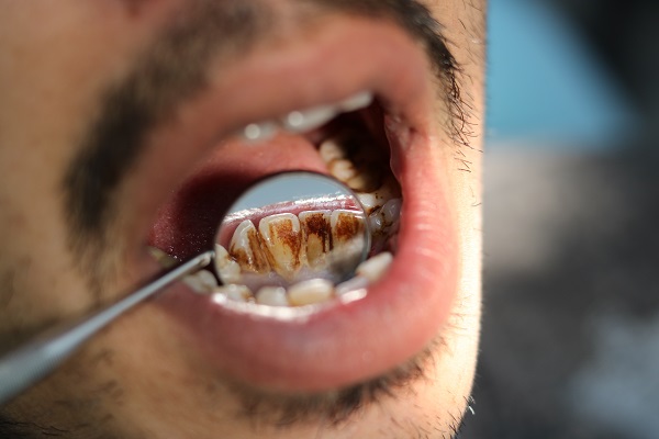 How Tooth Decay Puts The Entire Body At Risk